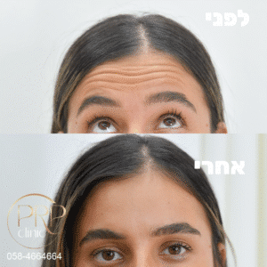 בוטוקס – מה זה באמת, למי זה מתאים ואיך נמנעים מפנים קפואות