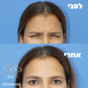לפני ואחרי בוטוקס בין הגבות