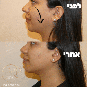 פיסול קו לסת