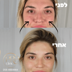 מילוי שקמטי חיוך
