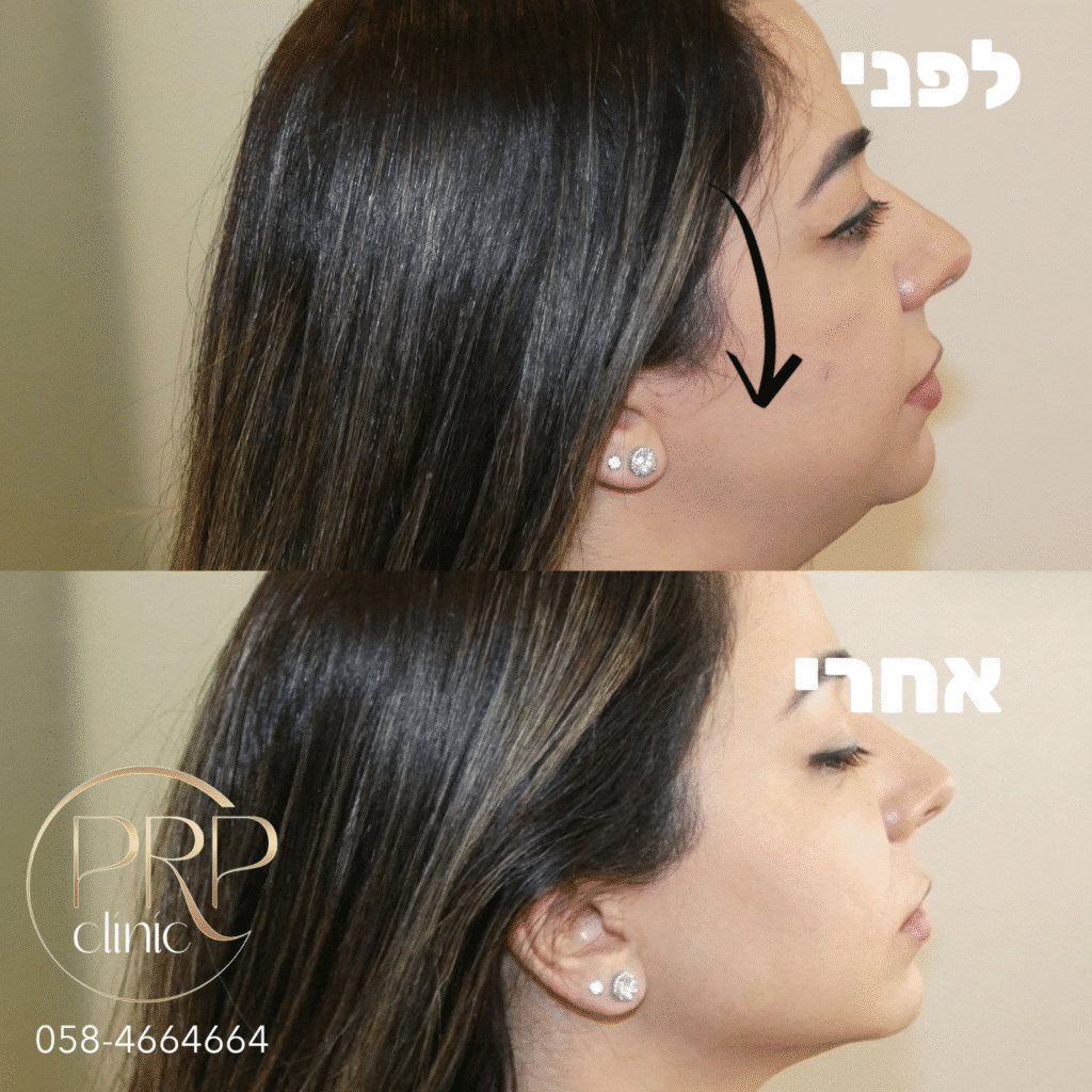 Jawline Contouring and Cheek filler for a woman