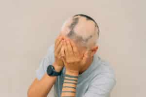 טיפול PRP באלופציה אראטה במרפאת PRP Clinic