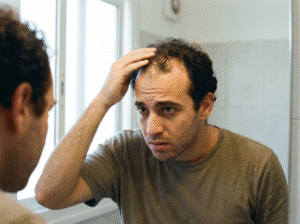 נשירת שיער גברית (Androgenetic Alopecia): האנטומיה של ההתקרחות והדרכים המוכחות לעצירתה